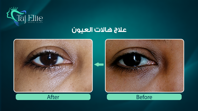 before-^-after10